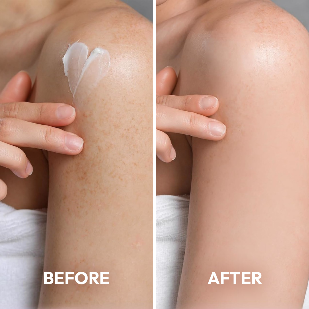 Advanced Triple-Acid Complex for Keratosis Pilaris