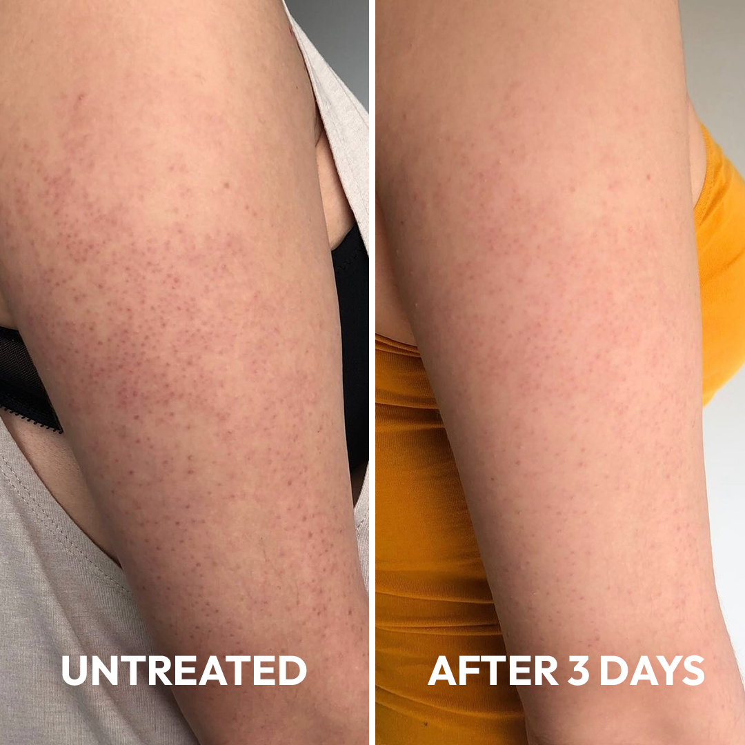 Advanced Triple-Acid Complex for Keratosis Pilaris