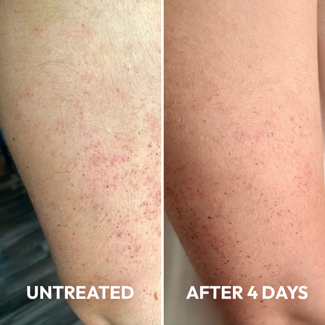 Advanced Triple-Acid Complex for Keratosis Pilaris