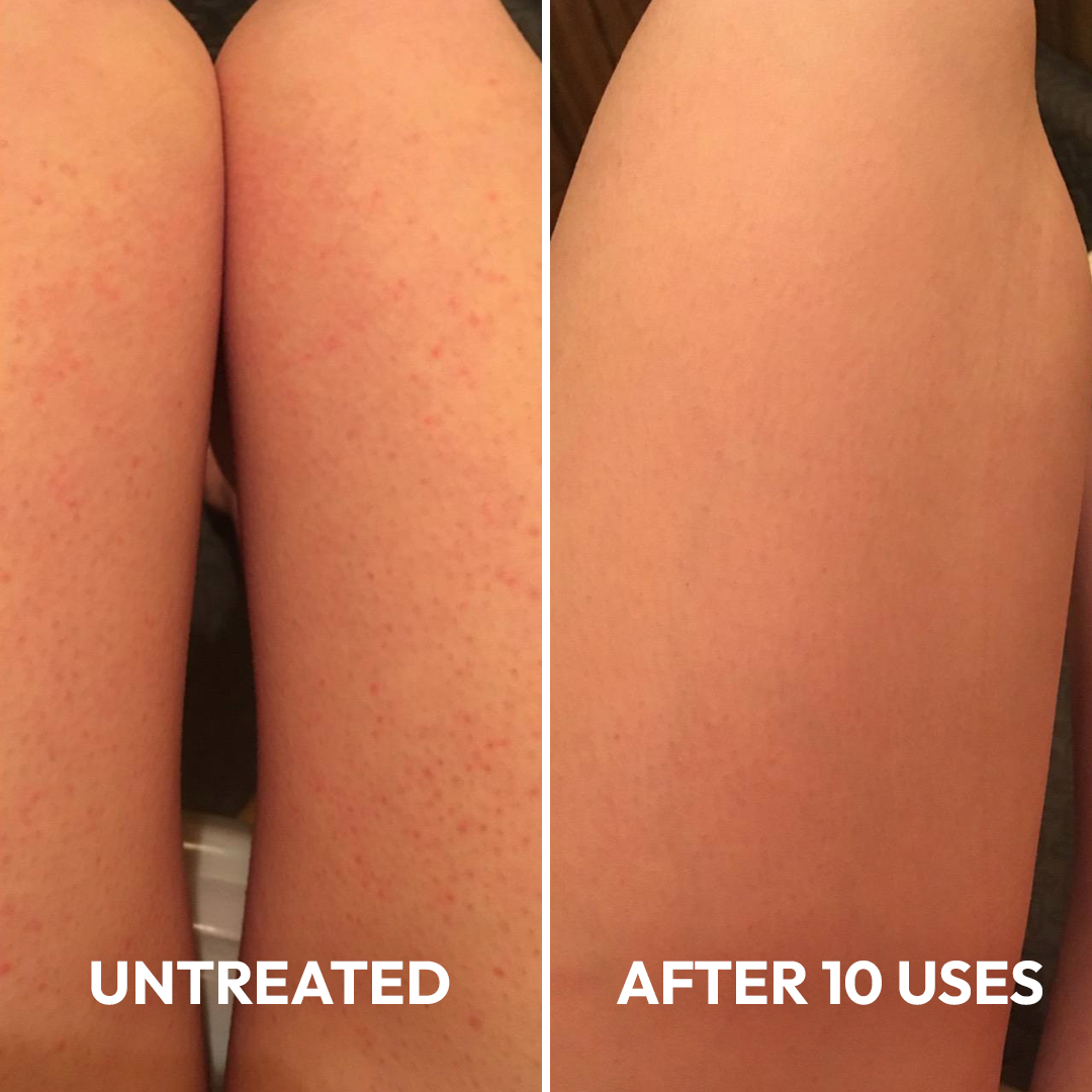 Advanced Triple-Acid Complex for Keratosis Pilaris