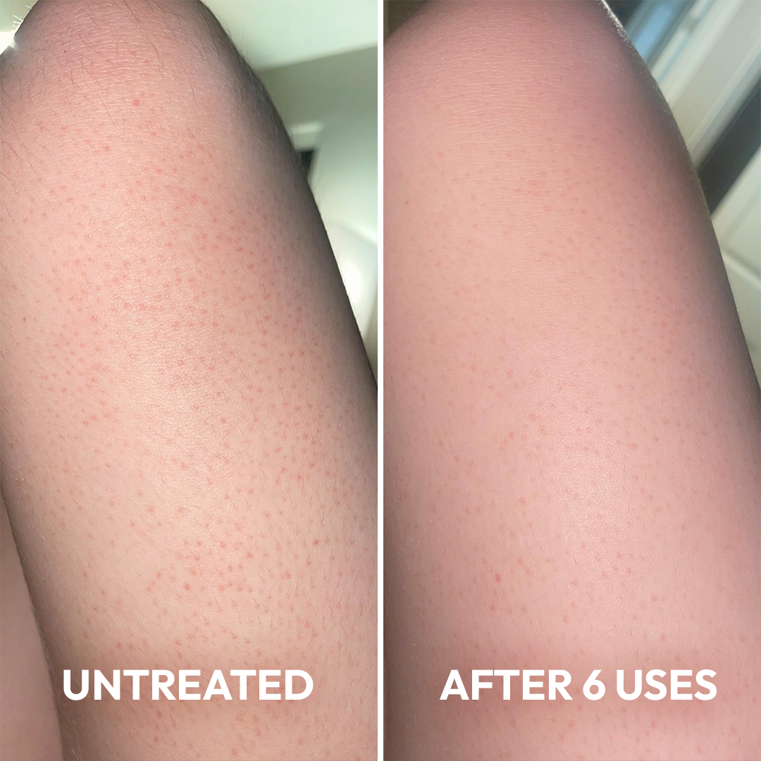 Advanced Triple-Acid Complex for Keratosis Pilaris