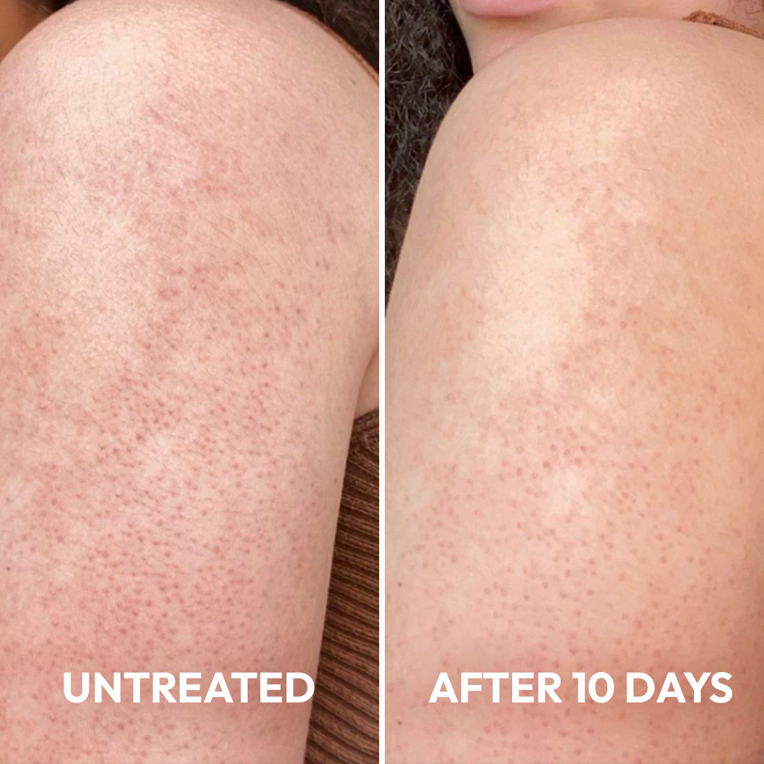 Advanced Triple-Acid Complex for Keratosis Pilaris