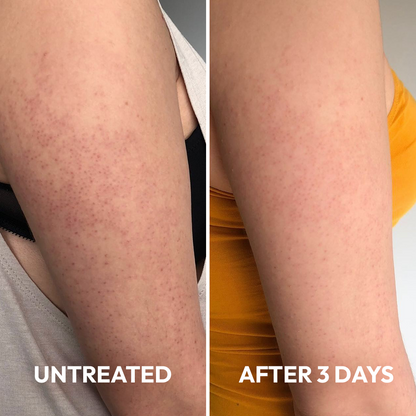 Advanced Triple-Acid Complex for Keratosis Pilaris