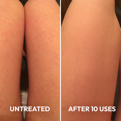 Advanced Triple-Acid Complex for Keratosis Pilaris