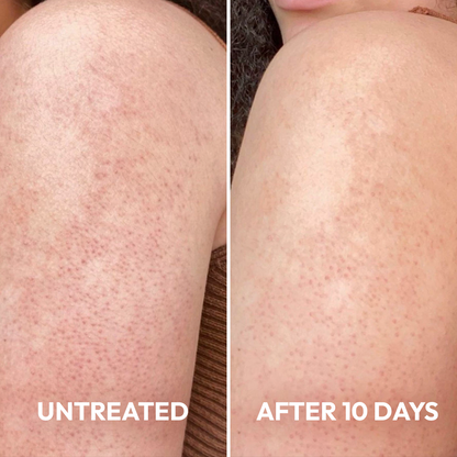 Advanced Triple-Acid Complex for Keratosis Pilaris